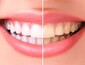 Отбеливание зубов: виды, их преимущества и недостатки