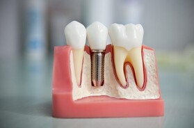 Цены на имплантацию зубов в Люберцах