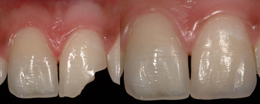 Восстановление зуба или художественная реставрация