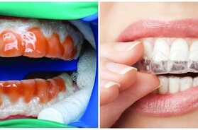 Способы отбеливания зубов - какой из них выбрать?