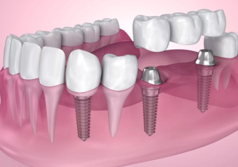 Имплантация жевательных зубов
